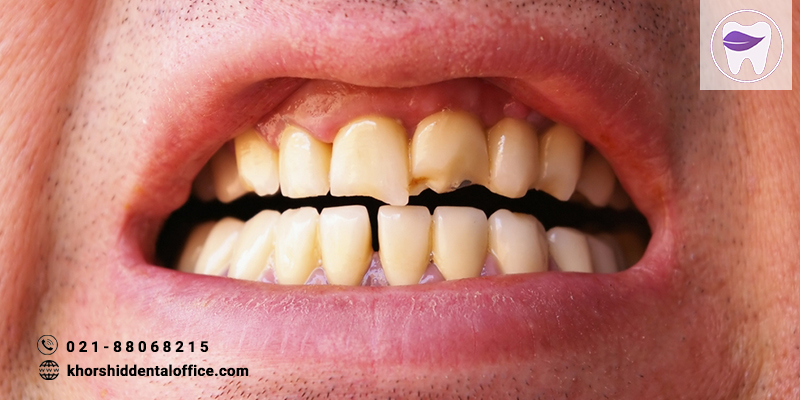 ترک خوردن دندان چه نشانه هایی دارد ؟