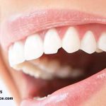 عوامل ترک خوردن دندان ها