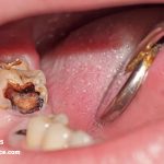 ترس از دندانپزشکی یکی از علل پوسیدگی دندان عقل