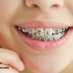 آیا می دانید زمان ارتودنسی دندان کودکان چه وقت است ؟