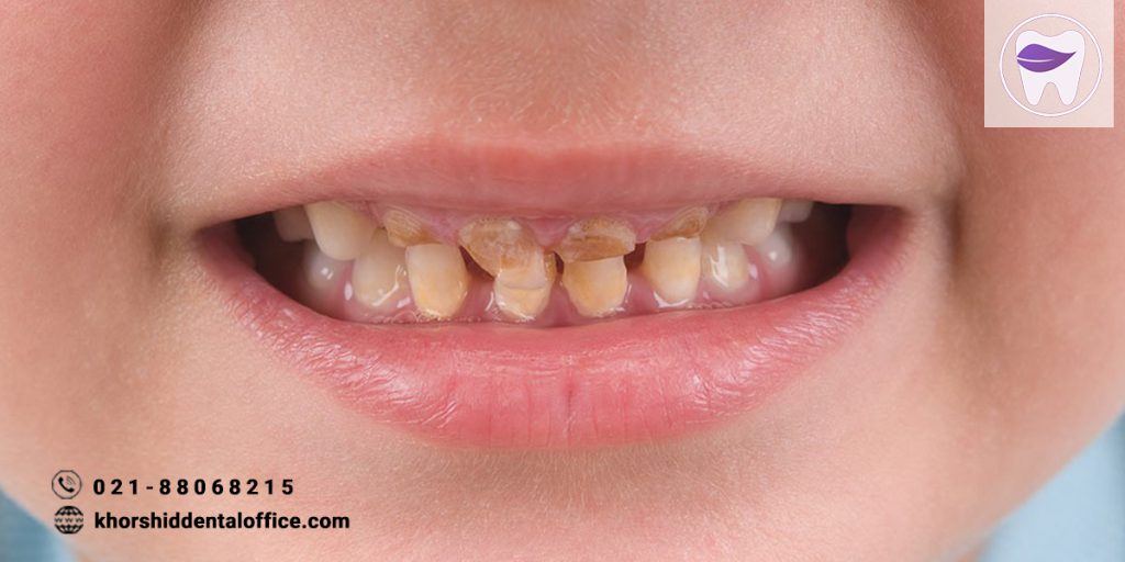 سیاه شدن دندان نوزدان و کودکان چه علتی دارد ؟
