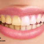 آیا می دانید علت تغییر رنگ کامپوزیت دندان چیست ؟