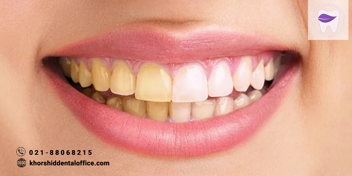 آیا می دانید علت تغییر رنگ کامپوزیت دندان چیست ؟