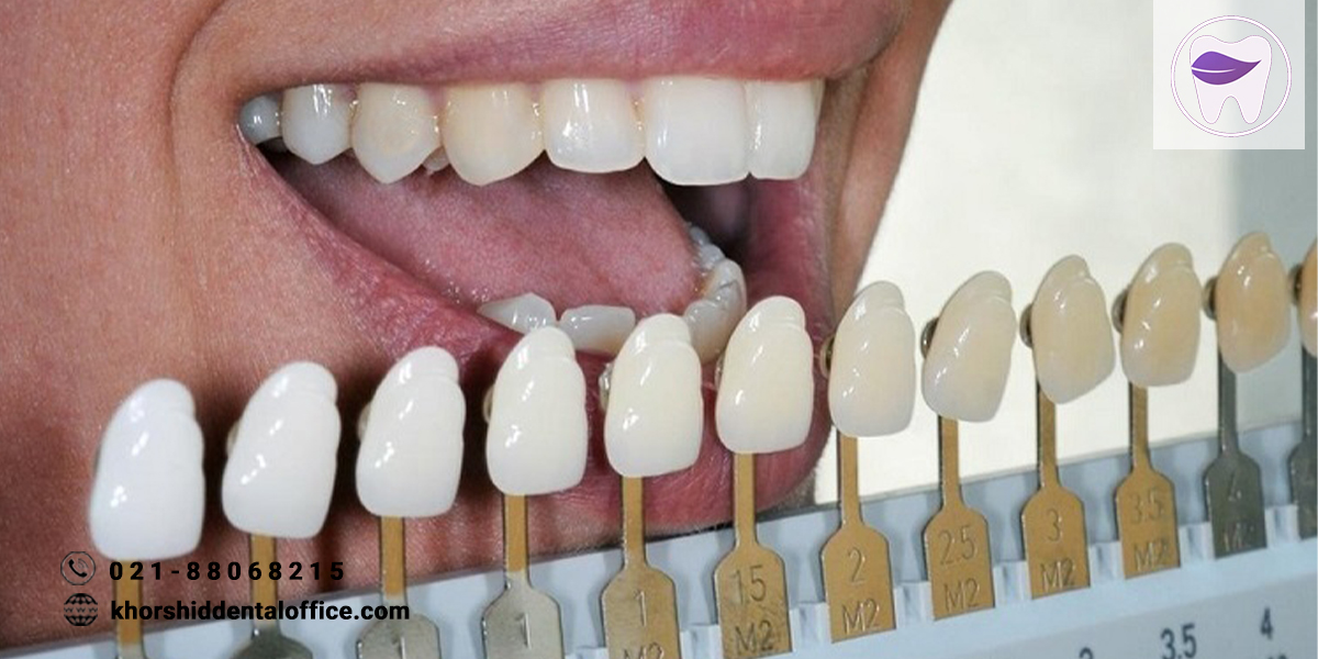 از انتخاب رنگ کامپوزیت دندان چه میدانید ؟