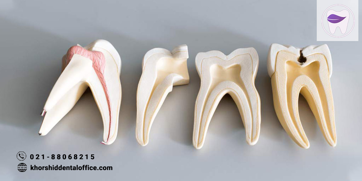آیا میدانید که هزینه عصب کشی دندان به چه عواملی بستگی دارد ؟