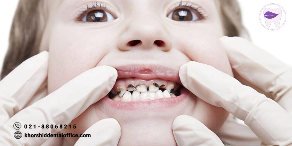 آیا میدانید سوراخ شدن دندان کودکان نشان از چه مشکلاتی است ؟