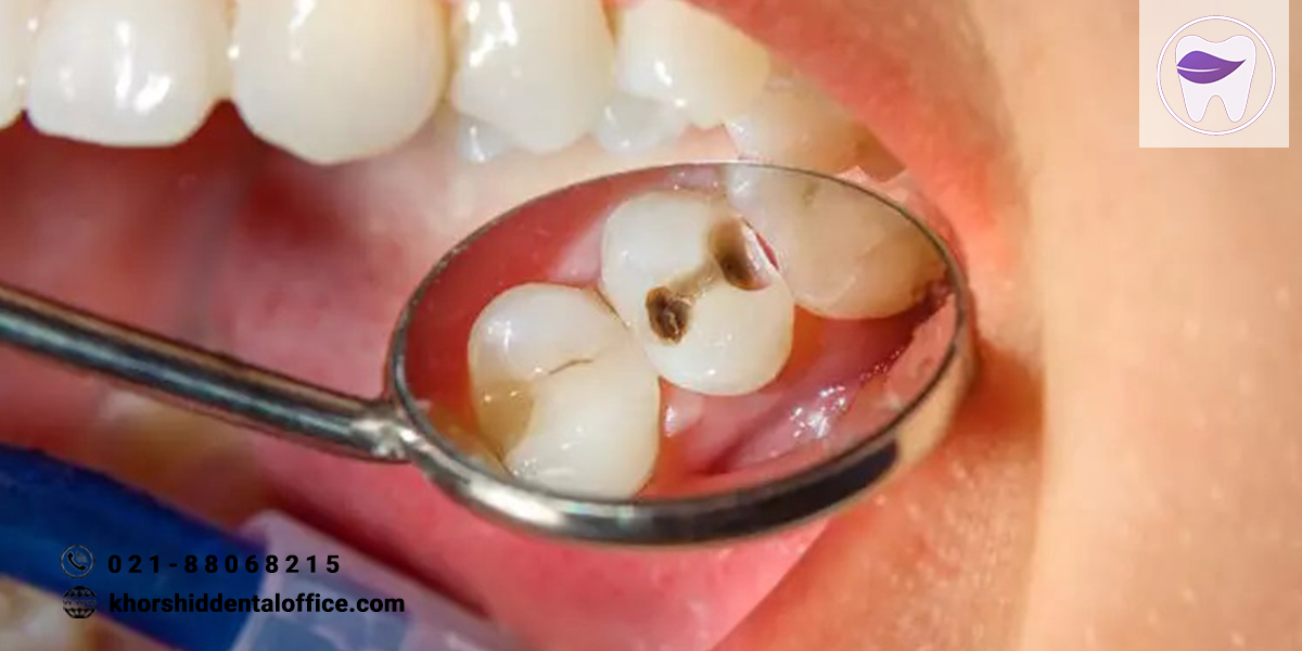 علت سوراخ شدن دندان کودکان چیست ؟