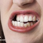 از علت سایش دندان چه اطلاعاتی دارید؟
