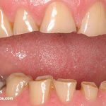 علت هایی از سایش دندان که لازم است بدانید