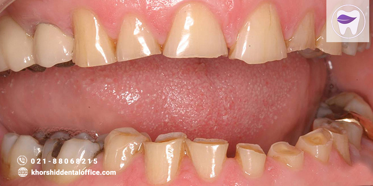 علت هایی از سایش دندان که لازم است بدانید