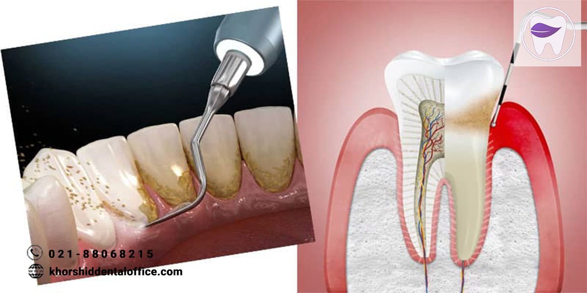 تفاوت بین جرمگیری لثه و جرمگیری دندان چیست ؟