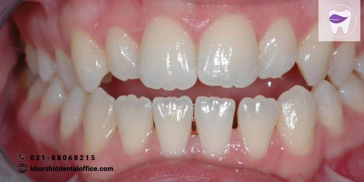 از ماملون دندان چه اطلاعاتی دارید ؟