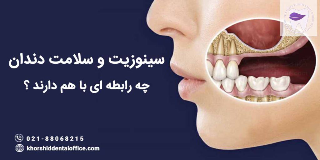 سینوزیت چه تاثیری در سلامت دندان ها دارد ؟