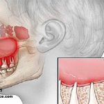 رابطه میان سلامت دهان و دندان و عفونت سینوس ( سینوزیت )