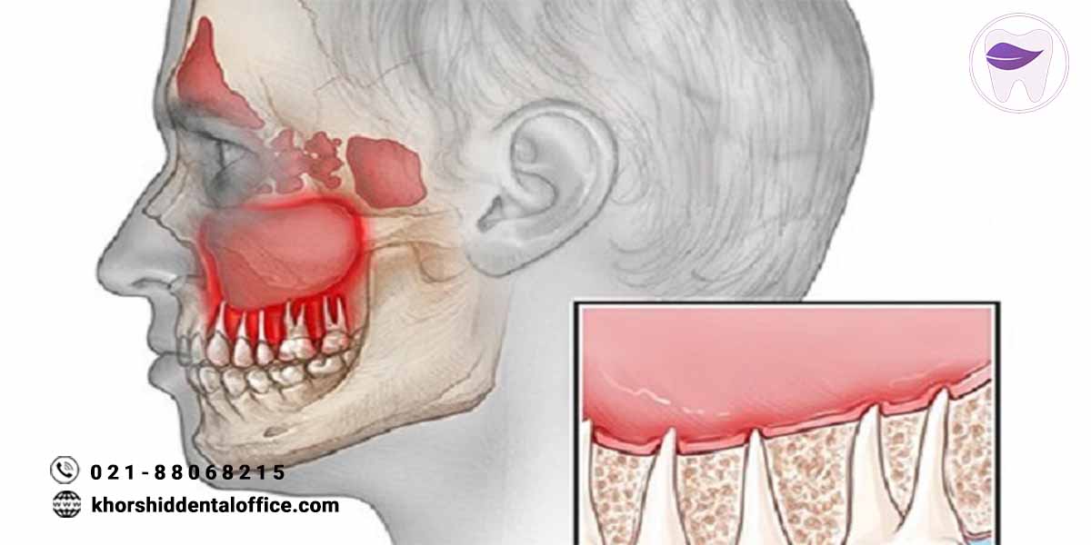 رابطه میان سلامت دهان و دندان و عفونت سینوس ( سینوزیت )