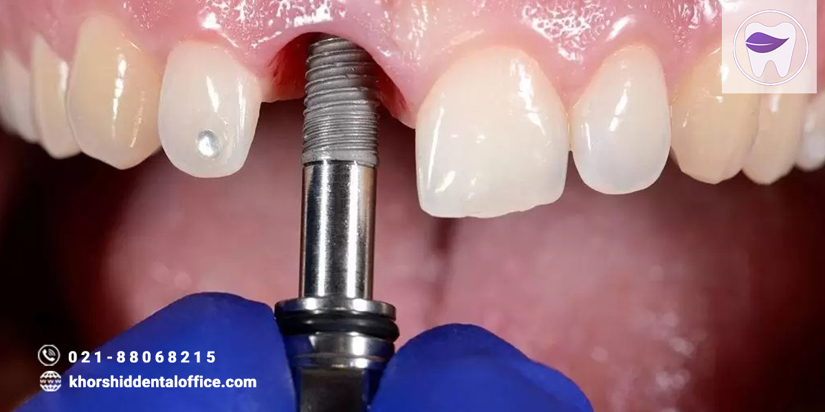ایمپلنت به روش پانچ دندان چگونه انجام میشود ؟