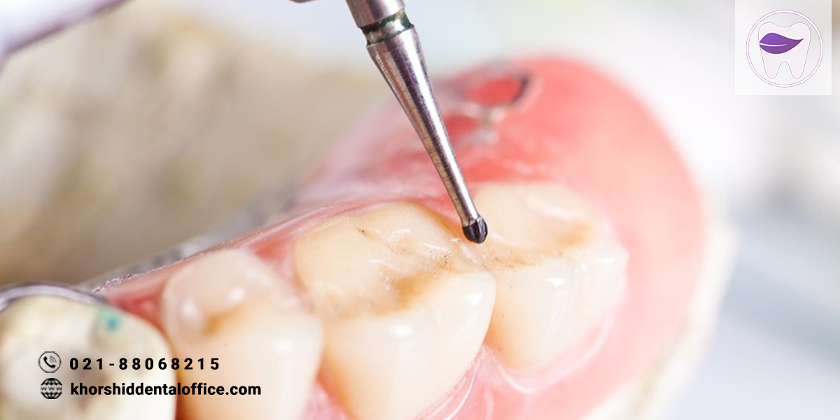 پالپوتومی دندان شیری کودکان چیست؟