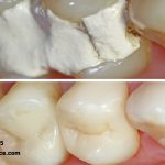 استفاده از پانسمان موقت دندان بعد از برخی درمان های دندانپزشکی